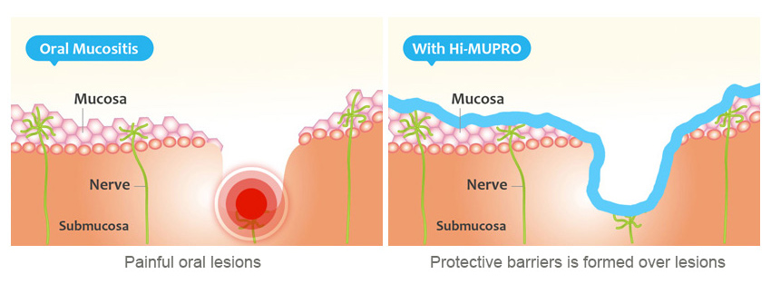 Rinçage buccal des plaies