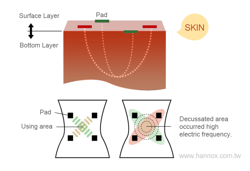 Deluxe Interferential Current Therapy
