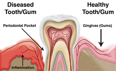 gum disease